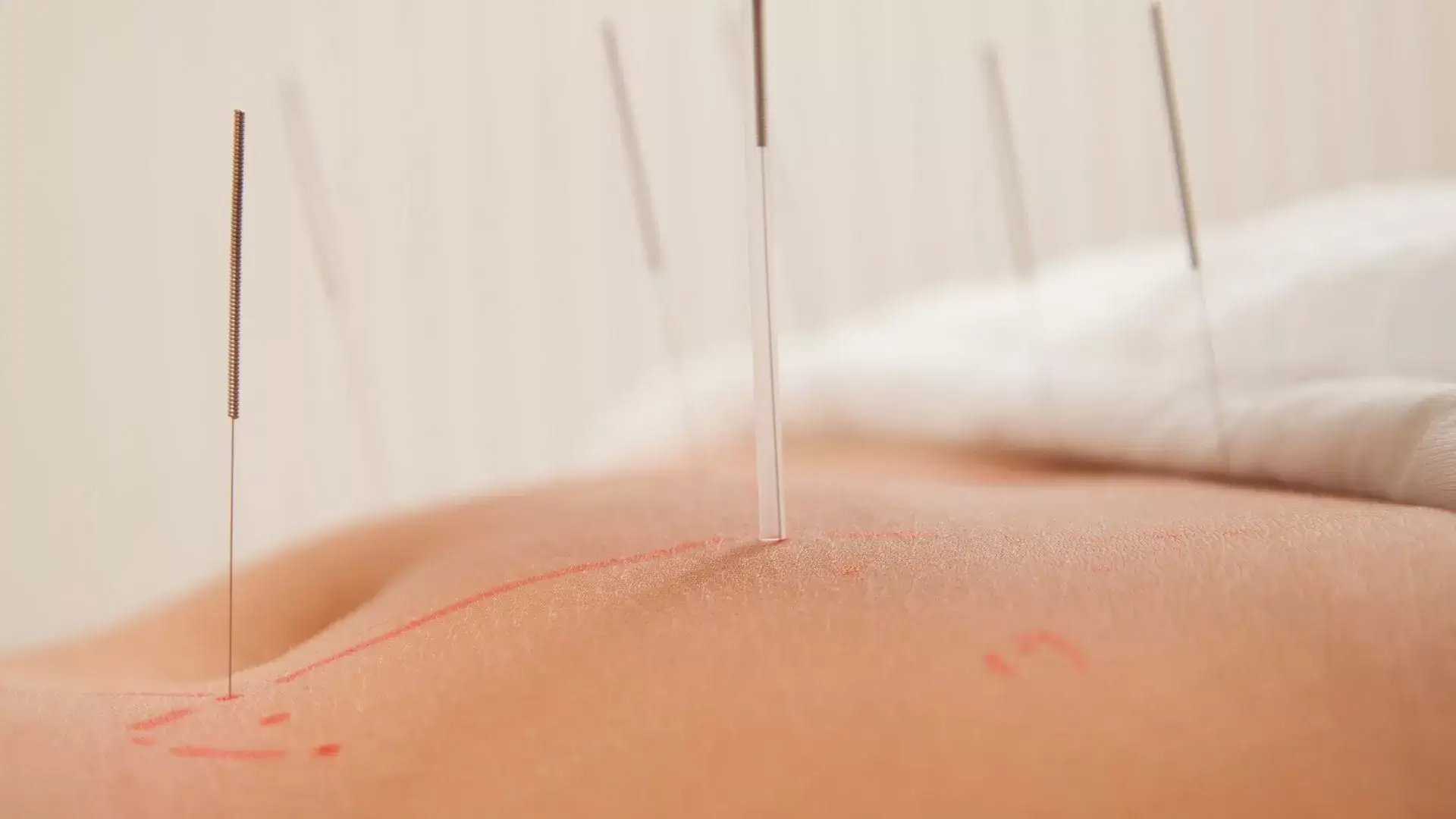 Frequently Asked Questions 16 How long will my course of acupuncture care last